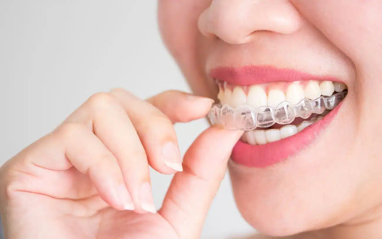 "How Often Should I Change My Aligners?"