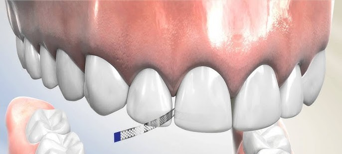 "IPR (Interproximal Reduction): Is It Safe and Why Is It Needed?"