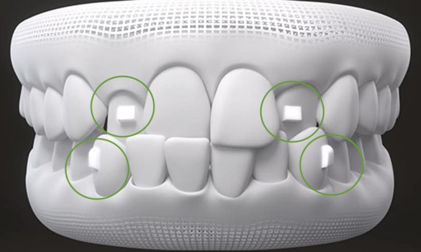 Straight Talk: Why Teeth Alignment Matters More Than You Think